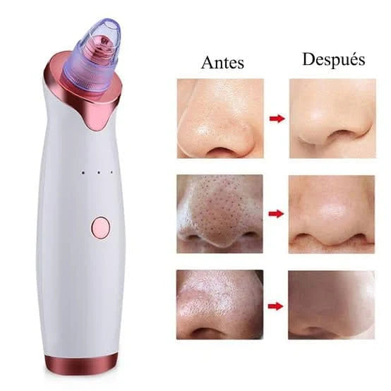 Extractor Profesional de Puntos Negros y Espinillas